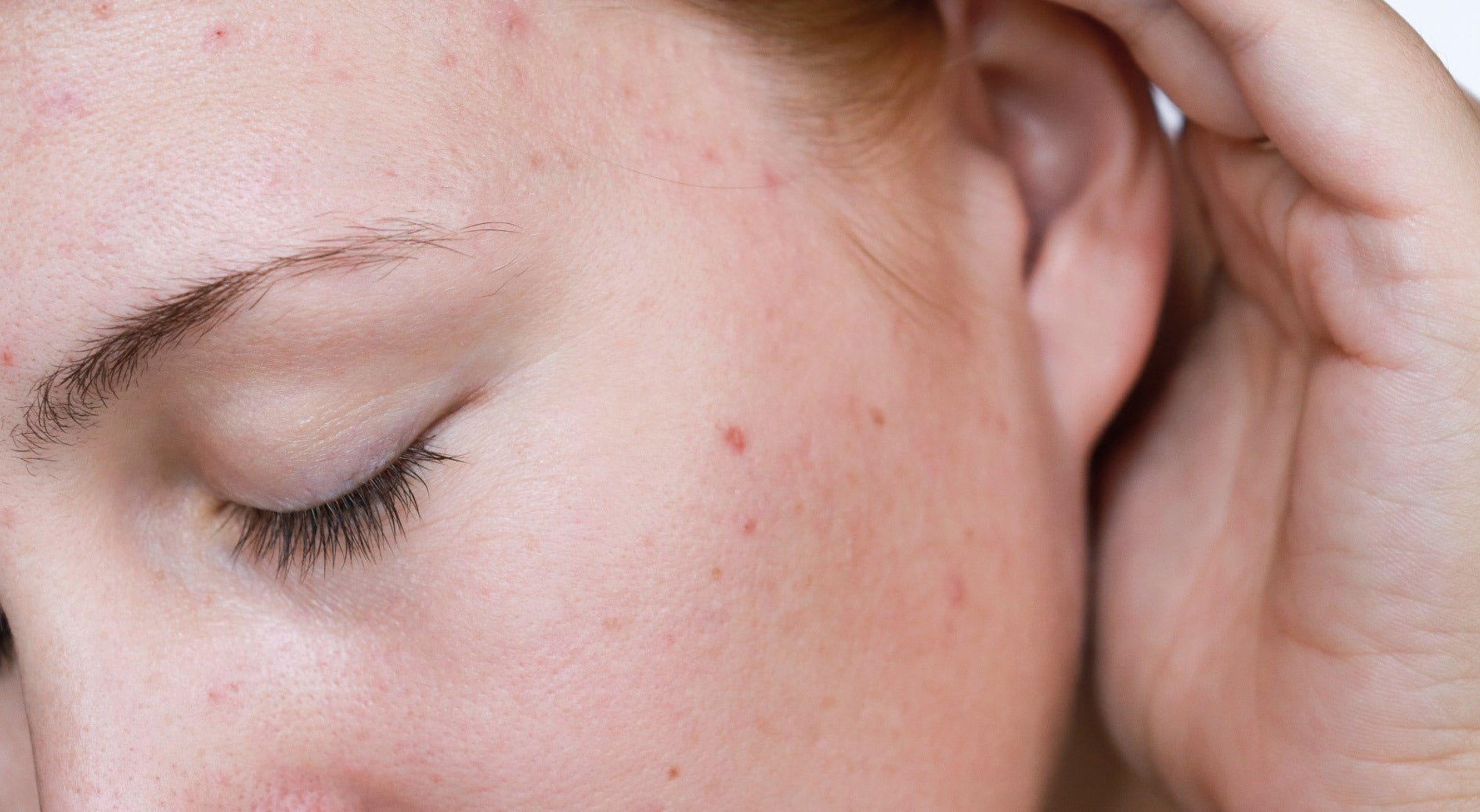 ¿Y si tus problemas de piel fueran por una intoxicación de cortisol?