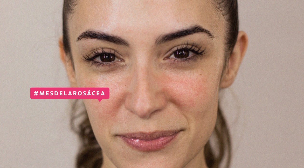 Rosácea: qué es, síntomas y cómo aprender a convivir con ella